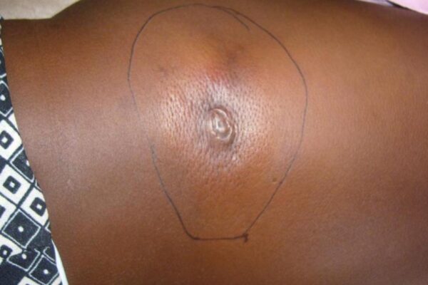 Adamawa Confirms Eight Deaths From Suspected Buruli Ulcer OutbreakÂ